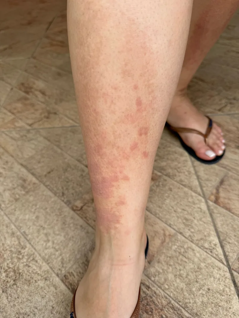 Alergia perna antes