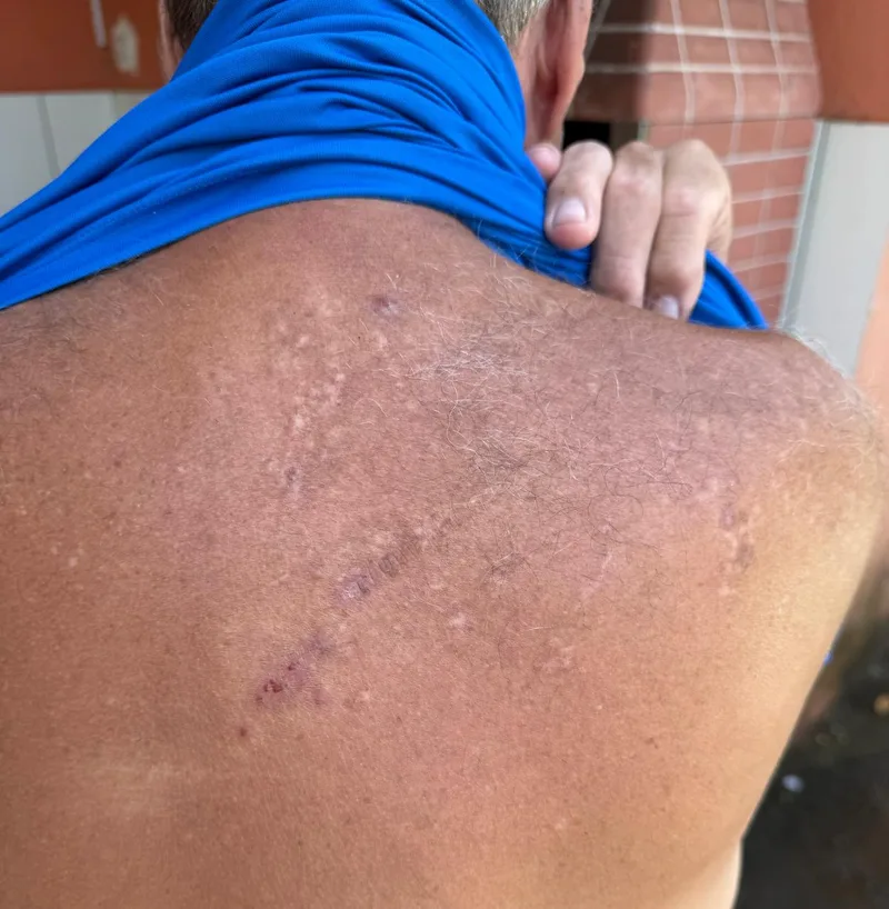 Alergia costas antes