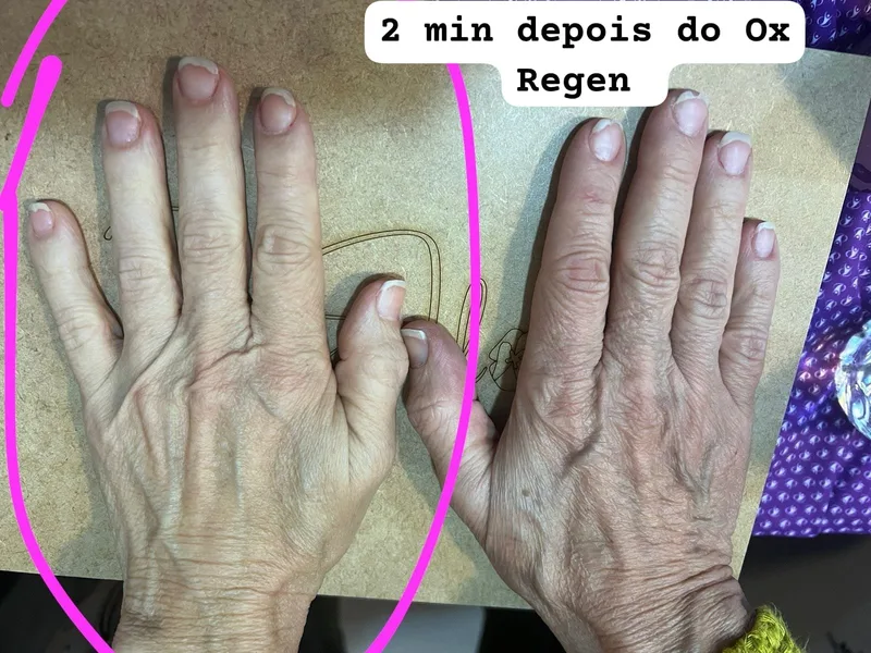 Mão depois OX REGEN